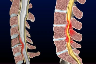 Spinalna stenoza